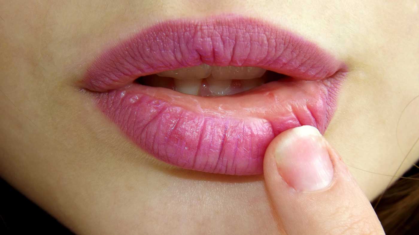 Ausgetrocknete Lippen